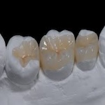 inlays dentaires dentiste Belkorchia